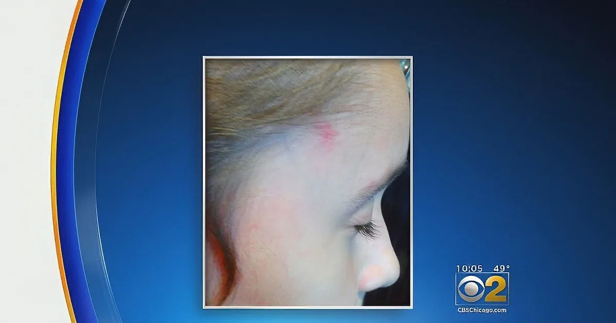 A close-up of a person's face with visible red marks, possibly from an injury or reaction.