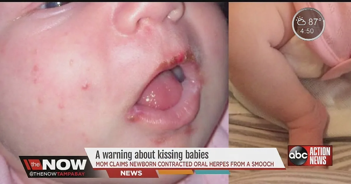 A baby with visible sores on the face and mouth, likely from herpes, is shown in a news broadcast.