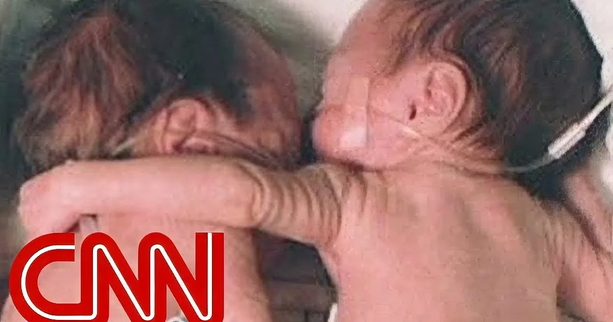 The Rescuing Hug: Dying Preemie Saved by Her Nurse... and Her Twin Sister!