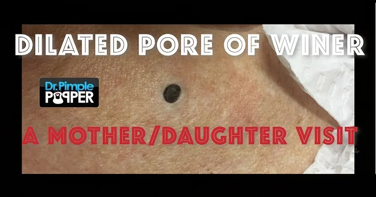 A close-up of a dilated pore on skin, with text indicating it's from "Dr. Pimple Popper" and mentioning a mother-daughter...